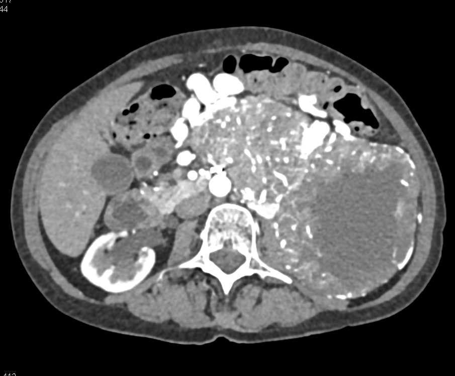 Large GIST Tumor with Neovascularity - CTisus CT Scan