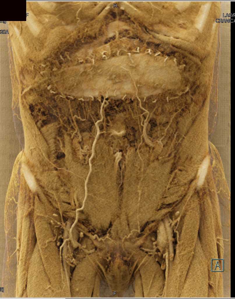 Mesh in Abdominal Wall with Cinematic Rendering - CTisus CT Scan