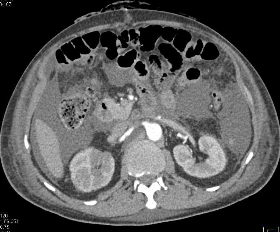 Ascites and Carcinomatosis - Gastrointestinal Case Studies - CTisus CT ...