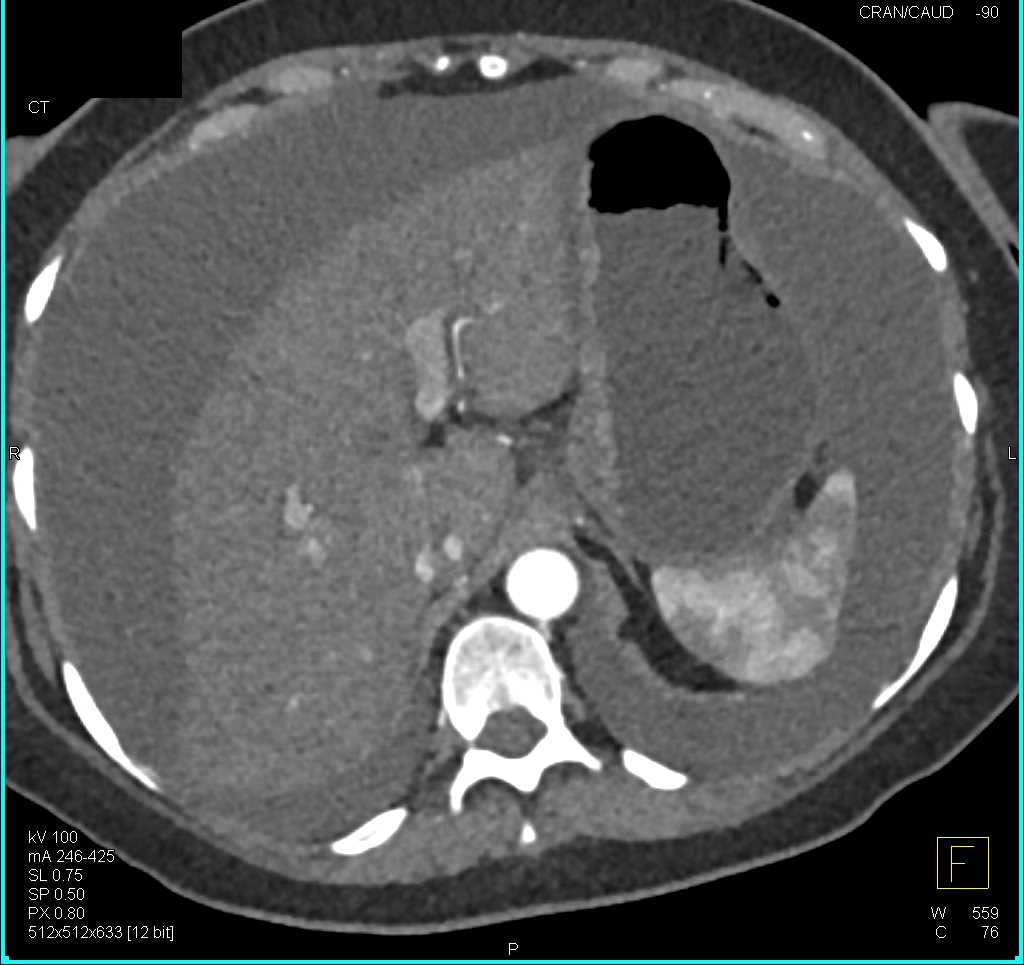 Ascites with Carcinomatosis - CTisus CT Scan