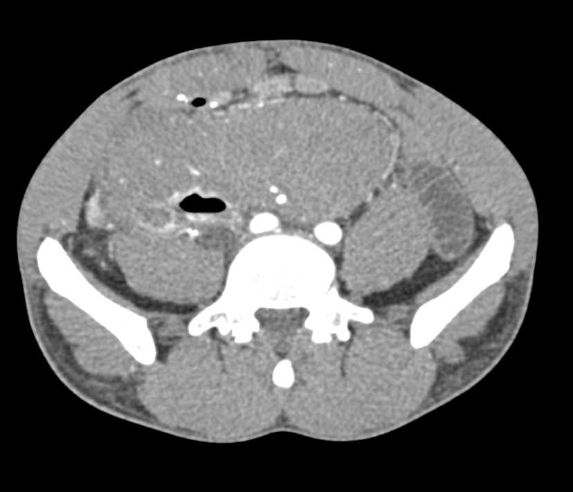 Desmoid Tumor - CTisus CT Scan