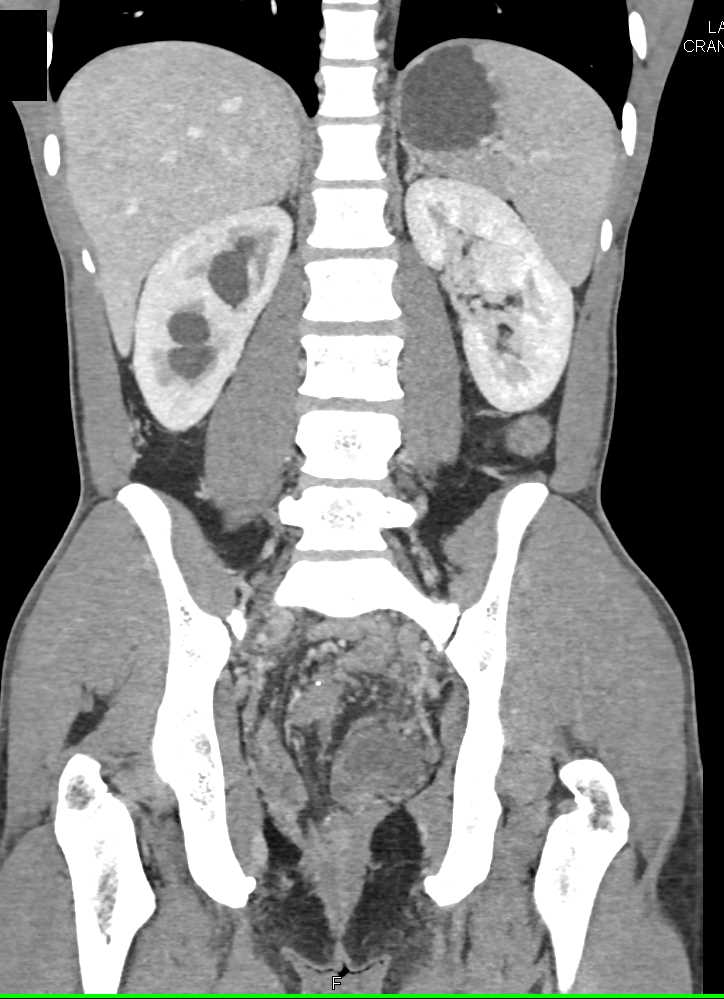 Desmoid Tumor - CTisus CT Scan