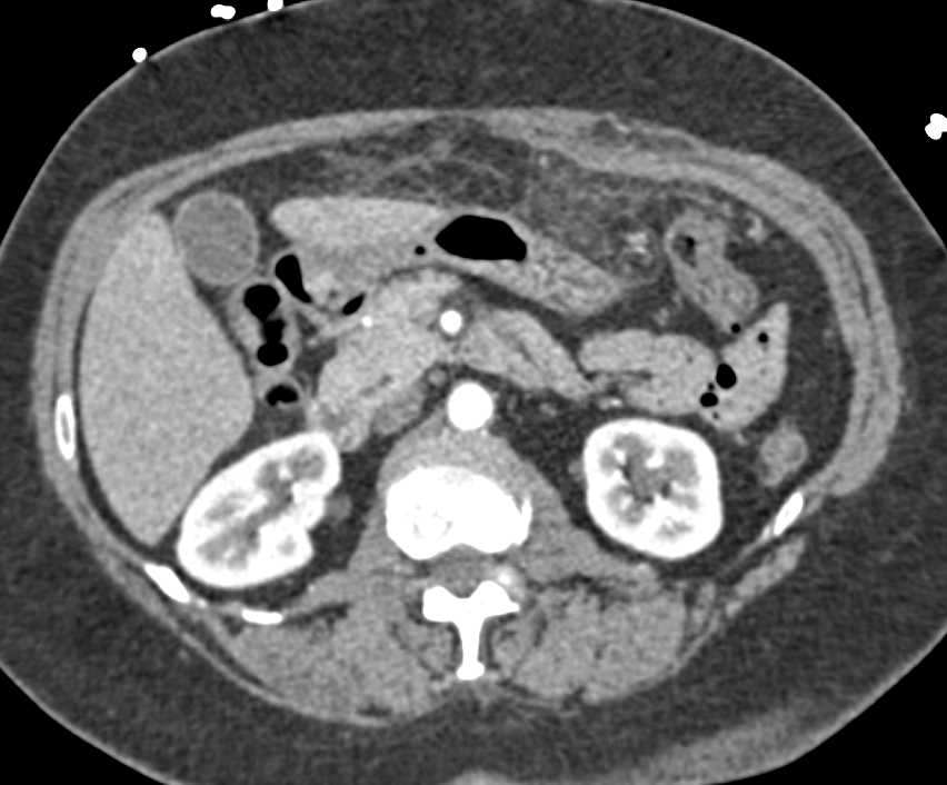 Omental Inflammation Simulating Carcinomatosis - CTisus CT Scan