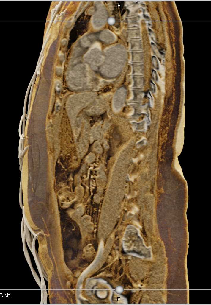 Omental Inflammation Simulating Carcinomatosis with Cinematic Rendering - CTisus CT Scan