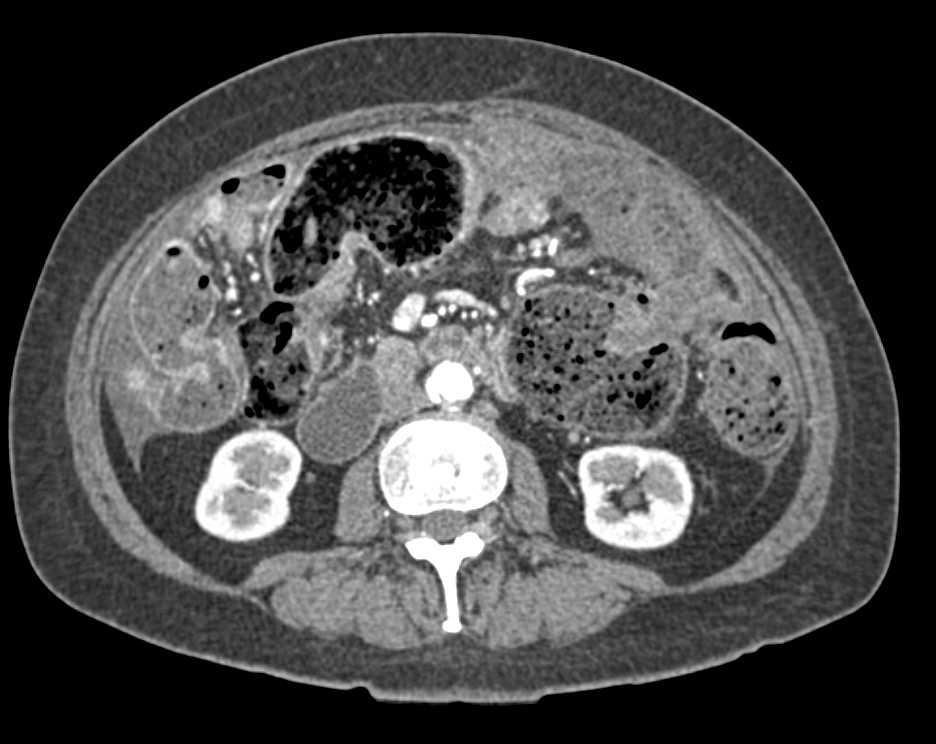 Pseudomyxoma Peritonei - CTisus CT Scan