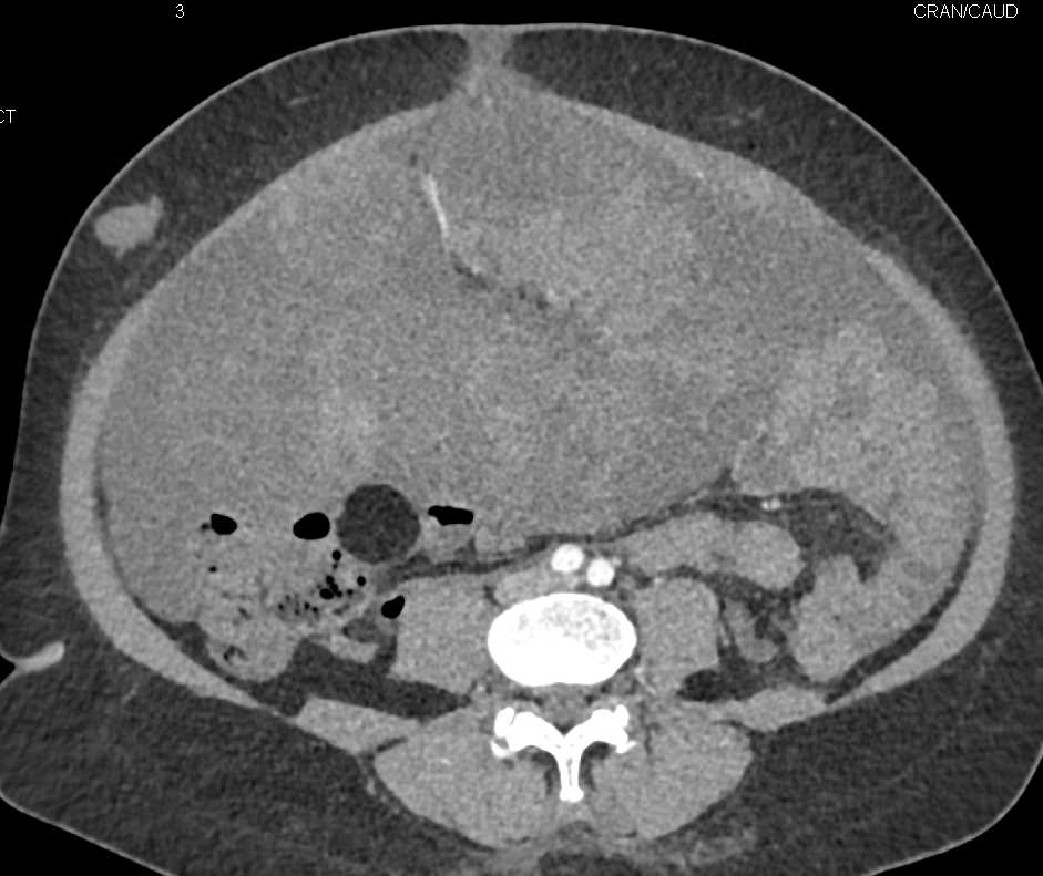 Carcinomatosis - CTisus CT Scan