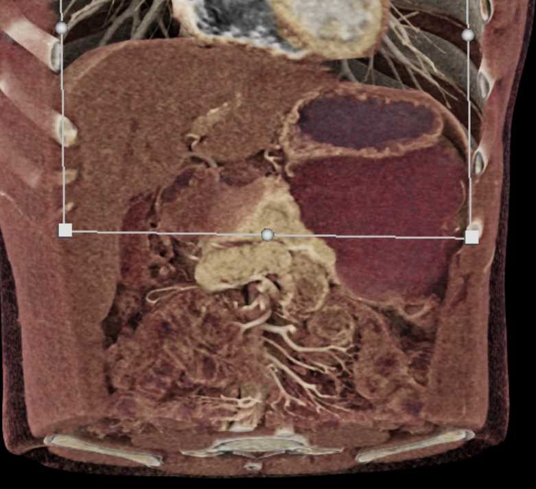 Cystic Lymphangioma - CTisus CT Scan