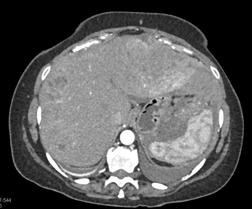 Carcinomatosis with Widespread Metastatic Colon Cancer - CTisus CT Scan