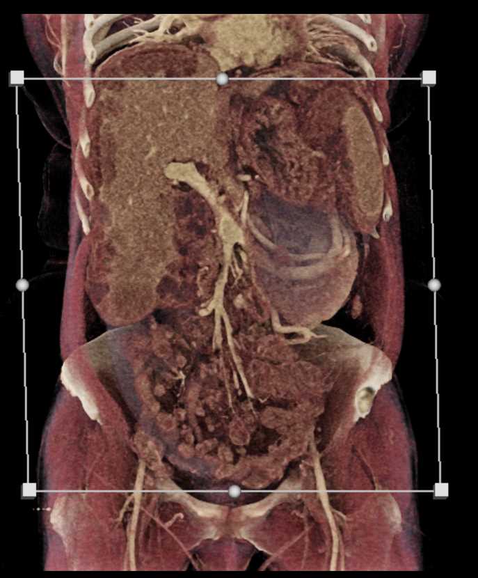 Carcinomatosis with Widespread Metastatic Colon Cancer - CTisus CT Scan