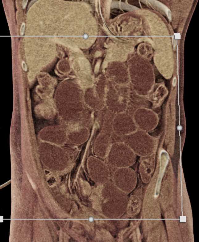 Distal Small Bowel Obstruction - CTisus CT Scan