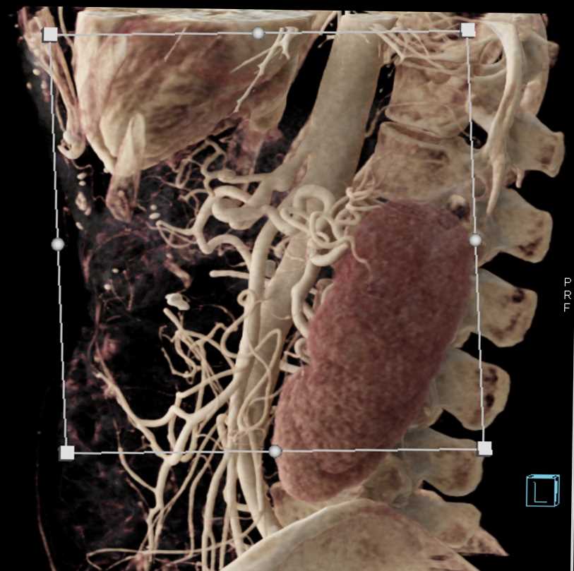 Recurrent Pancreatic Cancer Post Whipples - CTisus CT Scan