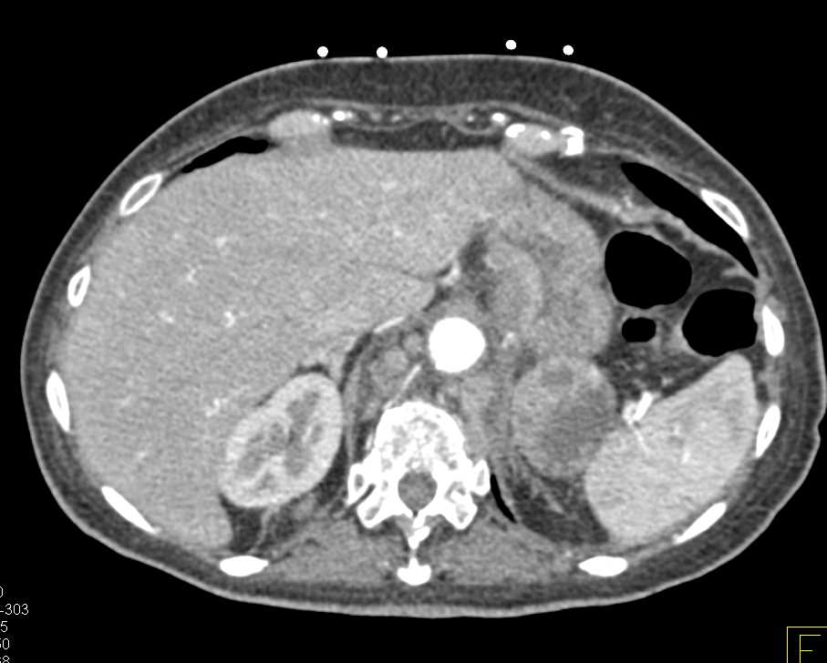 Lymphoma with Bulky Adenopathy - CTisus CT Scan