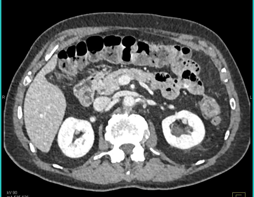 Multiple Neuroendocrine tumors - CTisus CT Scan