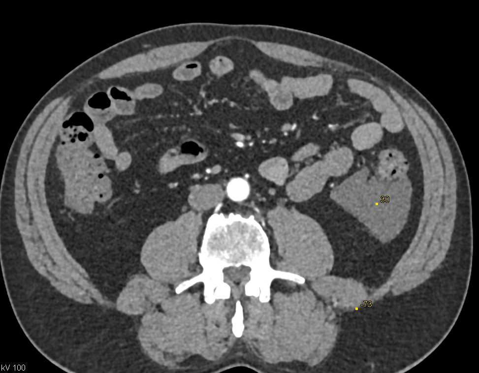 Lymphangioma LLQ - CTisus CT Scan