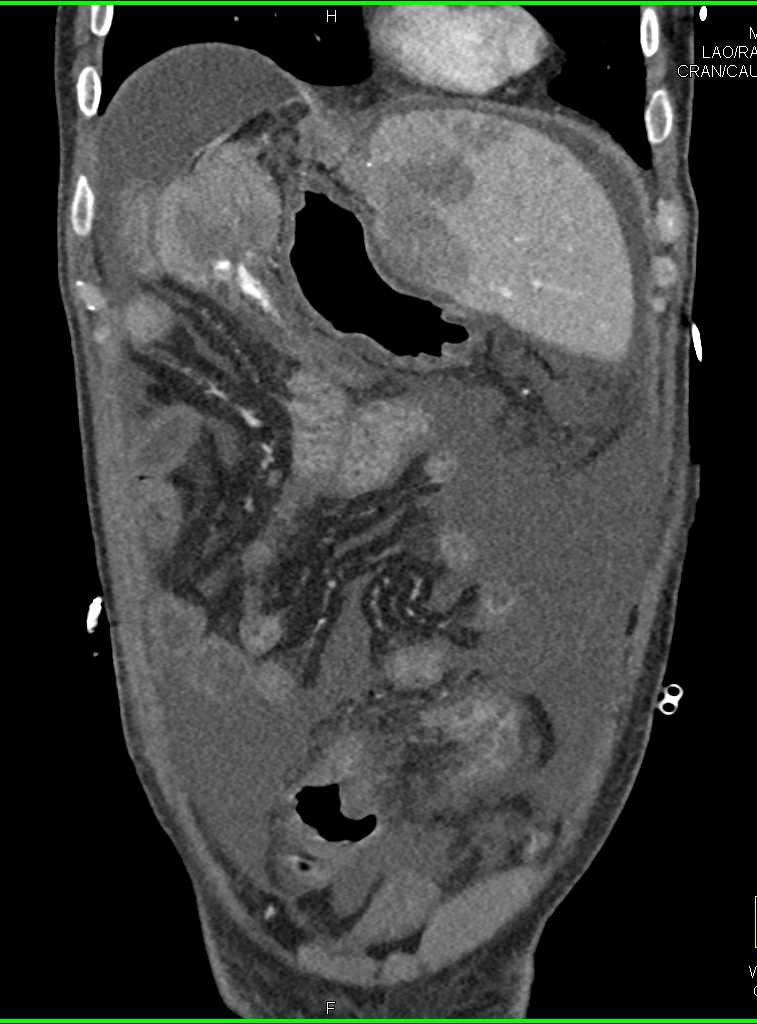 Situs Inversus - CTisus CT Scan