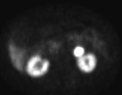 Metastatic Neuroendocrine Tumor - CTisus CT Scan