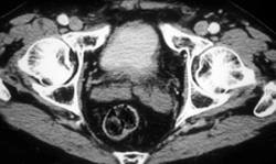 Enlarged Seminal Vesicles - CTisus CT Scan