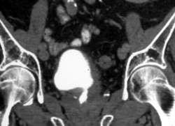 Narrowed Distal Left Ureter in Patient S/P Transurethral Resection of the Prostate (TURP) - CTisus CT Scan