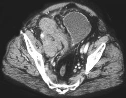 Retroperitoneal Bleed - CTisus CT Scan