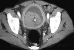 Hematoma in Bladder - CTisus CT Scan