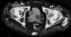 Bladder Cancer - CTisus CT Scan