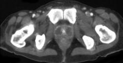 Prostatitis - CTisus CT Scan