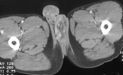 Scrotal Edema - CTisus CT Scan