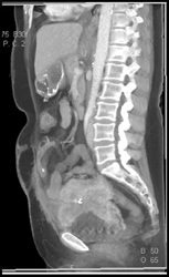 Sarcoma of the Bladder - CTisus CT Scan