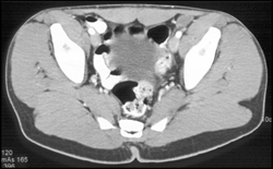 Undescended Testes on the Left - CTisus CT Scan