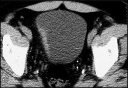 Bladder Cancer-9 Oclock - CTisus CT Scan