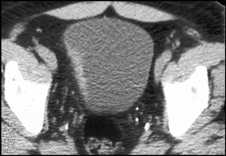 Bladder Cancer-easy to Miss on PET - CTisus CT Scan