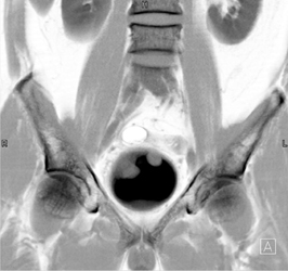 Bladder Cancer - CTisus CT Scan