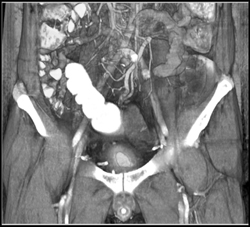 Fistulae From Bladder to Rectum - CTisus CT Scan