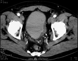 Bladder Cancer - CTisus CT Scan