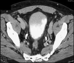 Bladder Cancer - CTisus CT Scan