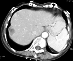 Implants on Liver From Bladder Cancer - CTisus CT Scan