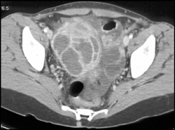 Tubo-ovarian Abscess- TOA - CTisus CT Scan