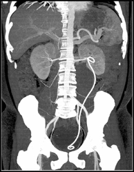 Ganglioneuroma Displaces Left Ureter - CTisus CT Scan