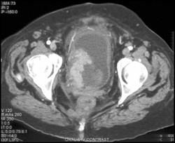 Bladder Cancer With Hemorrhage - CTisus CT Scan