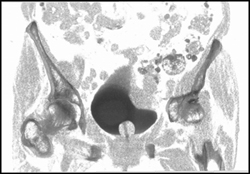 Diverticulitis Causing Colovesical Fistulae - CTisus CT Scan