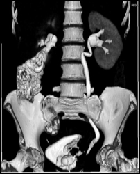 Bladder Cancer - CTisus CT Scan