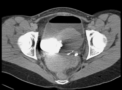 Bladder Cancer - CTisus CT Scan