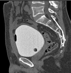 Normal Bladder - CTisus CT Scan