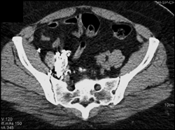 Post Lymphangioma - CTisus CT Scan