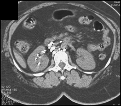 Reflux of Dye Into Right Renal Pelvis - CTisus CT Scan