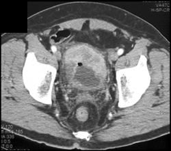 Bladder Cancer - CTisus CT Scan