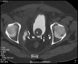 Leak S/P Prostatectomy - CTisus CT Scan