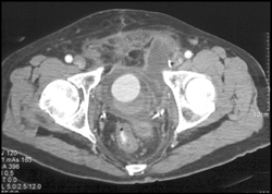 Internal Pudendal Artery Pseudoaneurysm S/P Cystoprostatectomy - CTisus CT Scan