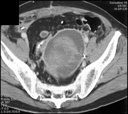 Hematoma Associated With Pseudoaneurysm - CTisus CT Scan