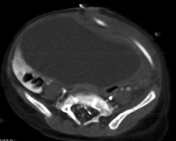 Supra-pubic Catheter Outside of Bladder With Contrast Now in Peritoneal Cavity - CTisus CT Scan